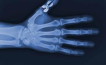 X-ray hand with violin thumb background